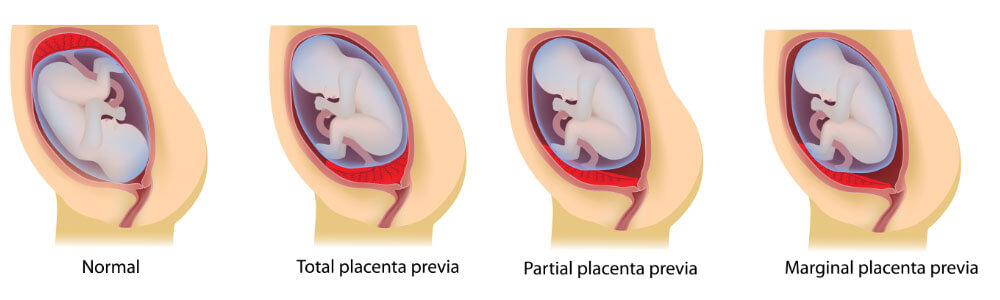 Placenta praevia, Placenta accreta, Vasa praevia - Diagnostic, riscuri, complicatii I Dr. Luiza Maria Guzga I Femmeboutiquemedical.com